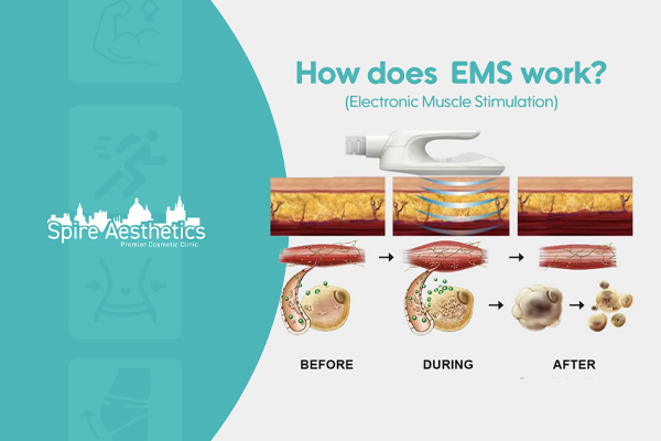 EMS treatment for post pregnancy weight loss treatment Eccles