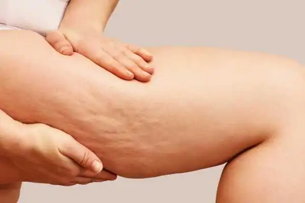 Image of woman showing leg with cellulite Eccles
