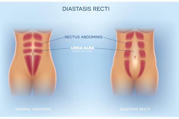 What Non-Surgical Options Are Available for Diastasis Recti Eccles?