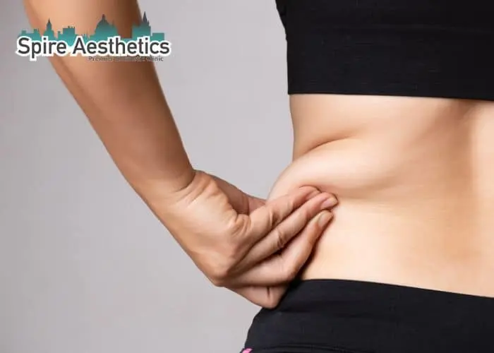 Image of woman pinching fat on their hips Eccles. Fat Freezing treatment