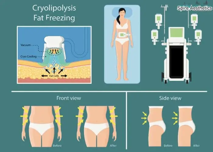 Fat freezing treatment Eccles benefits for competitions to remove stubborn fat deposits.