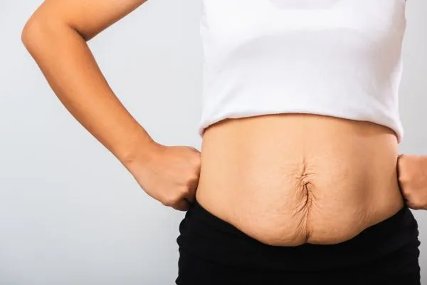 Image of a woman's stomach after weight loss with sagging skin following a gastric band Eccles