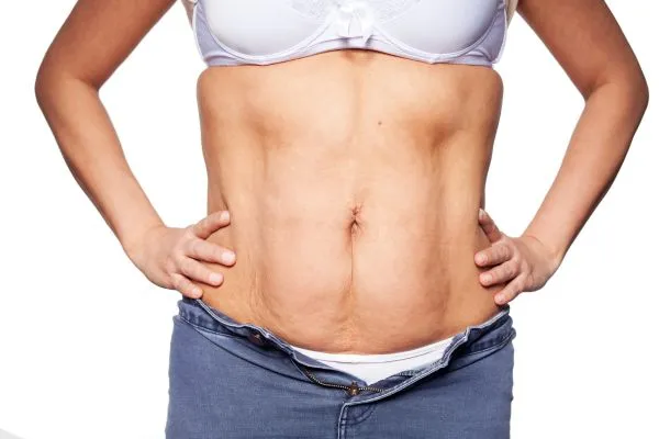 sagging skin on woman's stomach after weight loss injections Eccles