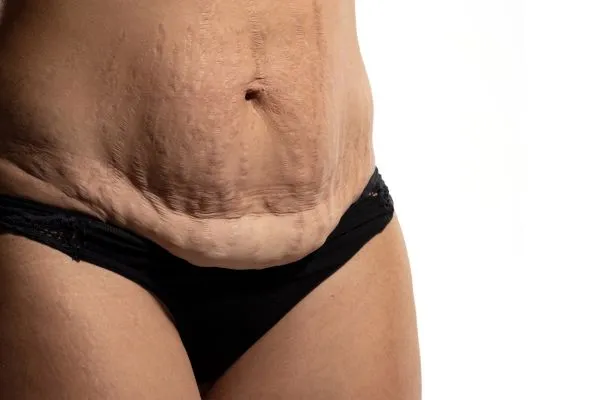 Image of womans stomach after weight loss injections Eccles showing saggy skin