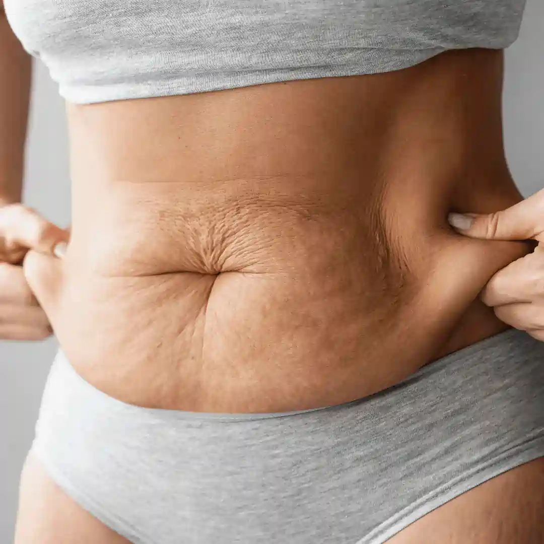 Is It Normal to Have Loose Skin After Pregnancy Eccles?