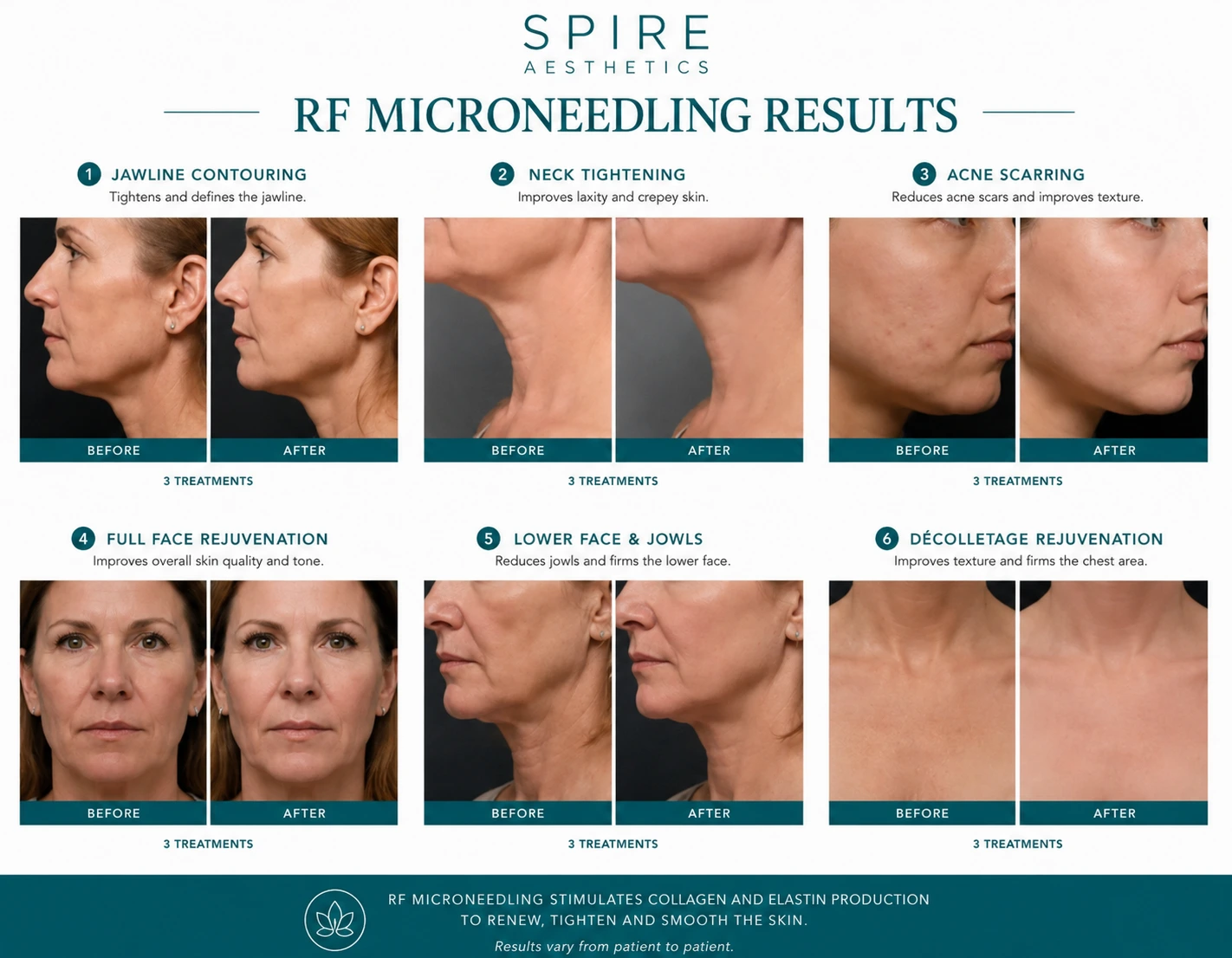 RF Microneedling Skin tightening Eccles results