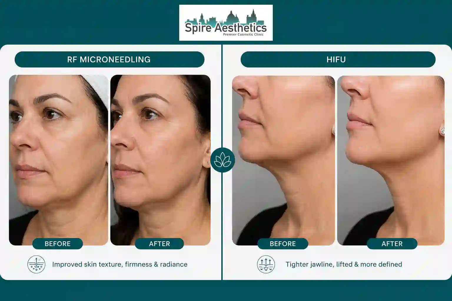 Can RF Microneedling and HIFU Be Combined Eccles?