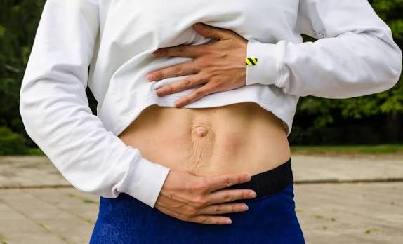 When Could Diastasis Recti Be the Missing Piece of the Puzzle Eccles?
