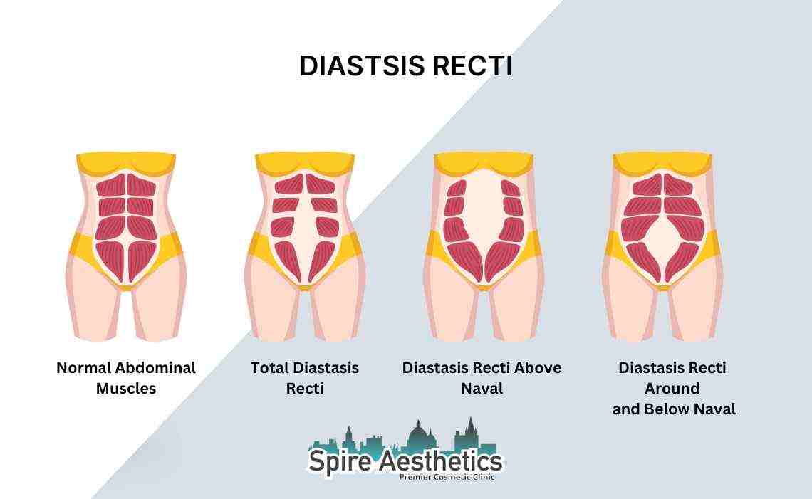 Is Non-Surgical Diastasis Recti Treatment Right for You? Common Concerns Answered Eccles